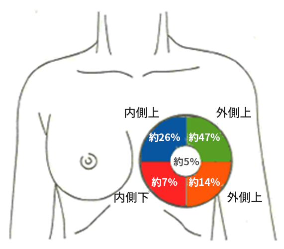 乳がんの好発部位
