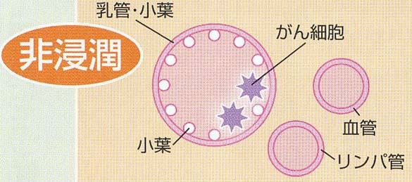 非浸潤