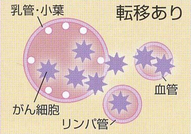 転移あり