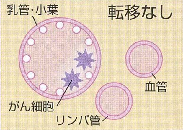 転移なし