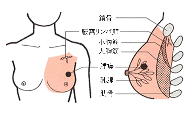 乳房を取る手術