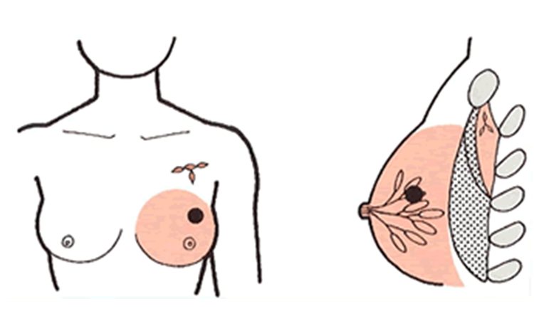 乳房を取るが、胸の筋肉を残す手術